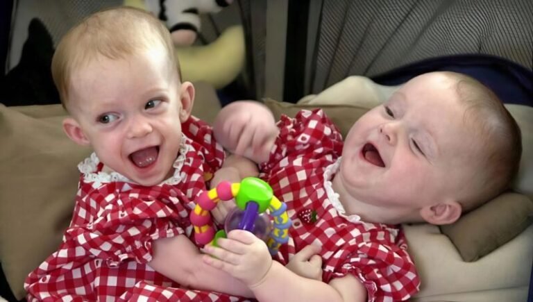 These conjoined twin sisters were born in 2000 and were connected from the chest to the pelvis. They had two torsos but shared internal organs 😱 When the girls were seven months old, doctors decided to separate them. The 31-hour surgery was successful, and both sisters survived 😍 The most interesting part is that one of the sisters recently became a mother 💖 Curious to see how the sisters look 25 years after the separation? Their before/after photos are in the first comment 👇👇