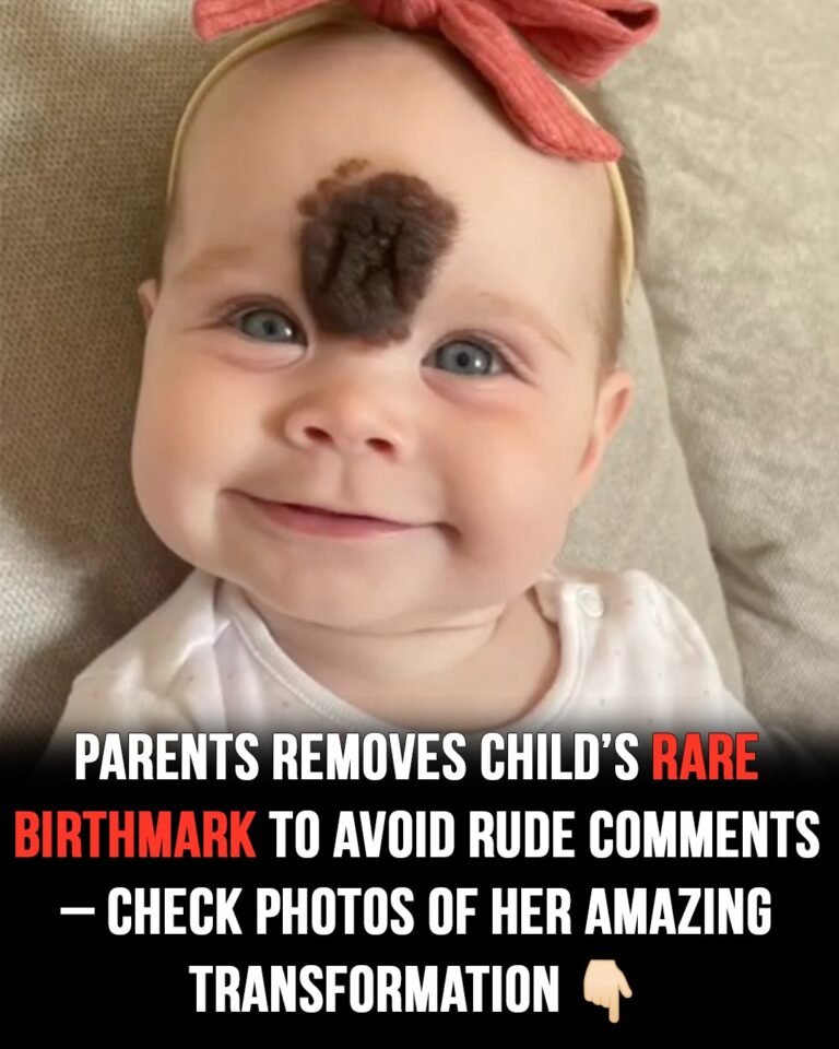 Cruel reactions force parents to remove baby’s rare birthmark