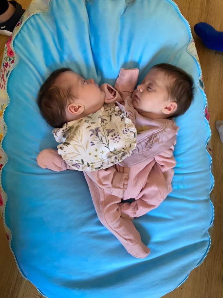 Doctors separated conjoined twins who were joined at the chest: here’s what they look like 3 years later