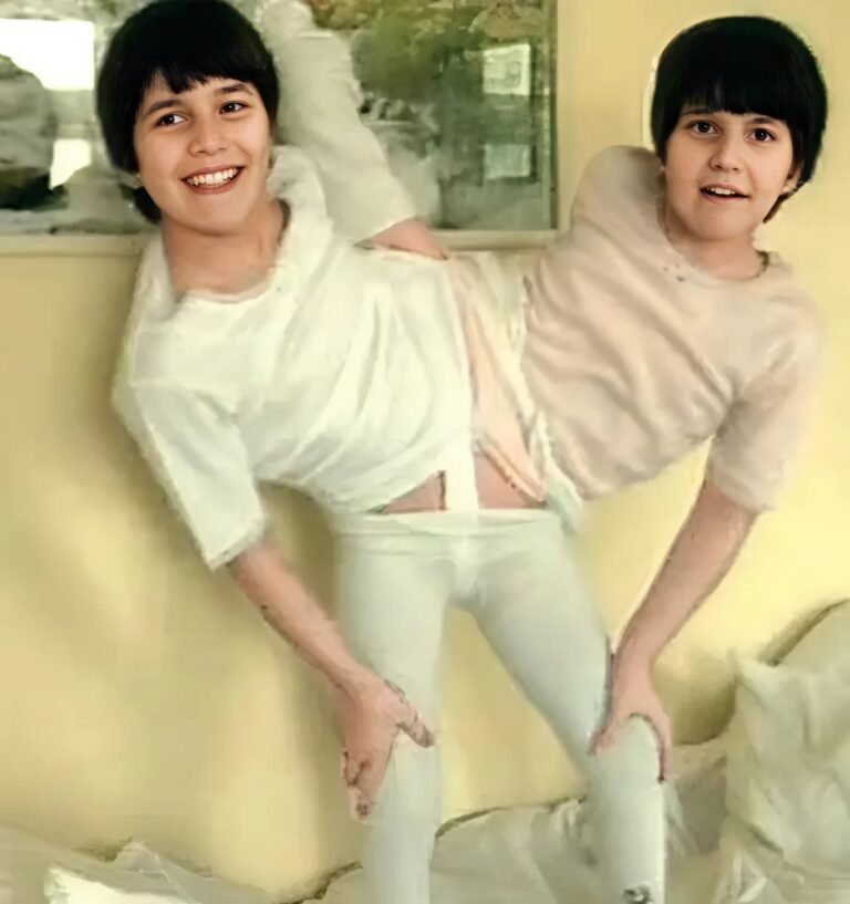 These sisters were conjoined twins born fused at the pelvic area They shared a common intestine, reproductive organs, and had three legs When they were 11 years old, doctors decided to perform the complicated surgery to separate the sisters The surgeons needed 12 hours to separate them and remove the third leg How the sisters look after the operation was shown in the first comment