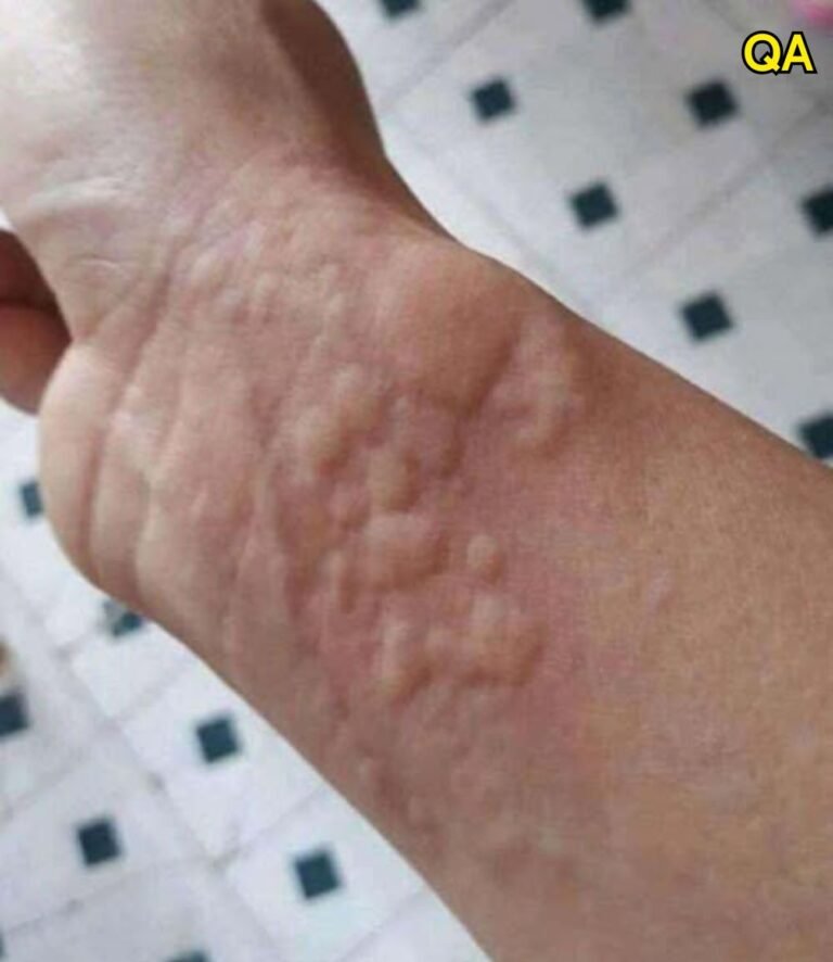 The Hidden Danger on Your Skin: Why Hives and Breathing Changes Are Serious Warning Signs You Should Never Ignore10
