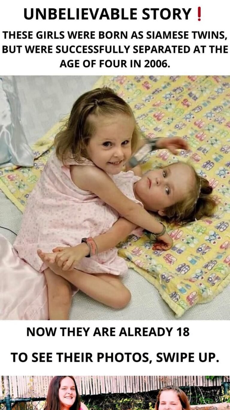 From Separation to Success: The Inspiring Journey of Siamese Twins Separated at Age 4