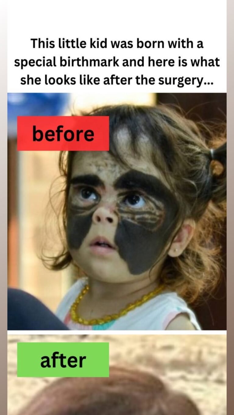 This little kid was born with a special birthmark and here is what she looks like after the surgery…